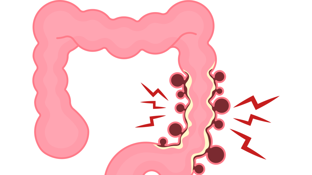 Complicações da Doença de Crohn